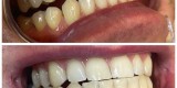 Wybielanie zębów - Dental white spa | Uroda, makijaż ślubny Radom, mazowieckie - zdjęcie 2