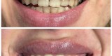 Wybielanie zębów - Dental white spa | Uroda, makijaż ślubny Radom, mazowieckie - zdjęcie 3